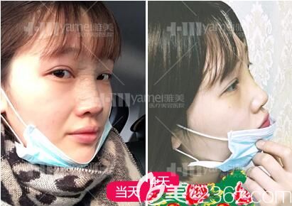 鼻整形術(shù)后3天樣子 鼻整形術(shù)后3天樣子