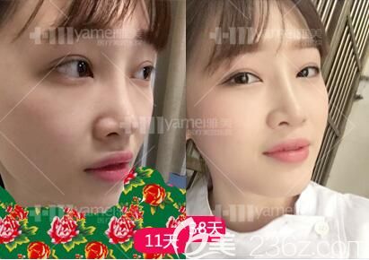 鼻整形拆線后恢復(fù)效果 鼻整形拆線后恢復(fù)效果