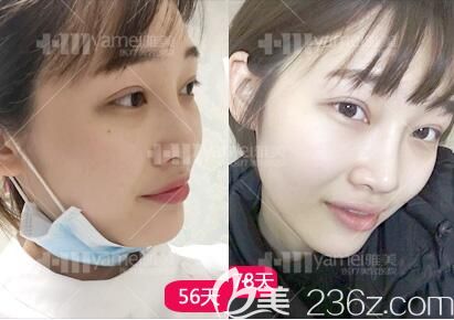 做完鼻整形術(shù)后1個(gè)月后效果情況 做完鼻整形術(shù)后1個(gè)月后效果情況