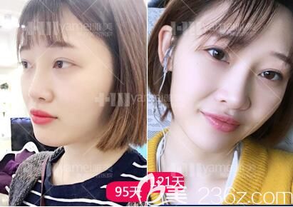 在長沙雅美做完鼻整形術(shù)后3個(gè)月后恢復(fù)效果情況 在長沙雅美做完鼻整形術(shù)后3個(gè)月后恢復(fù)效果情況