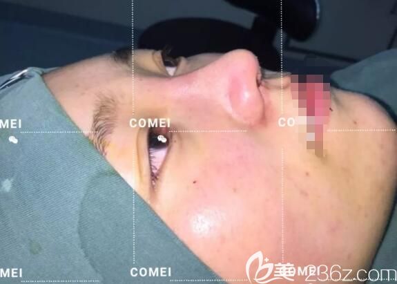 在南通康美剛做完膨體隆鼻術后即刻