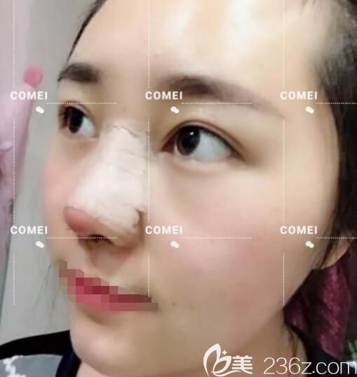 做完膨體隆鼻術后兩天恢復中