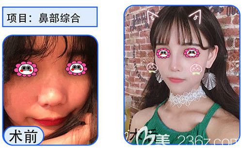 無錫坤如瑪麗隆鼻變化圖