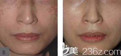 王瑩醫(yī)生激光祛斑案例 王瑩醫(yī)生激光祛斑案例