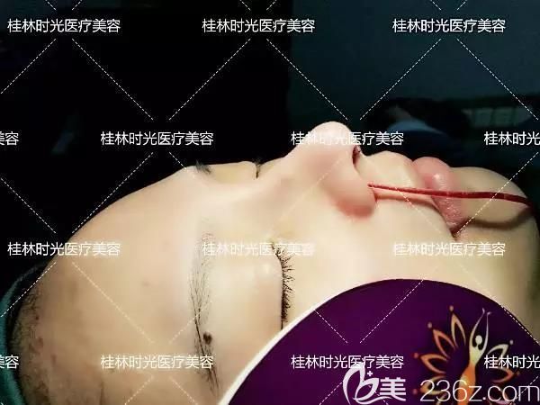 桂林時光院長給我做鼻綜合手術中