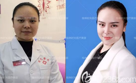 我在桂林時光整形做鼻子和下巴前后對比照片