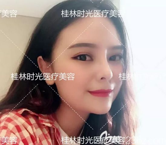 實拍:我在桂林時光整形做膨體+肋軟骨鼻綜合隆鼻及假體隆下巴真實恢復(fù)期圖片