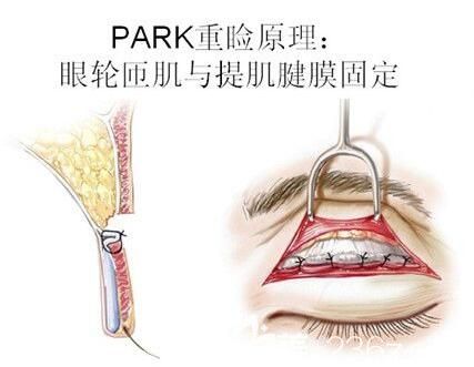 PARK法雙眼皮手術(shù)原理