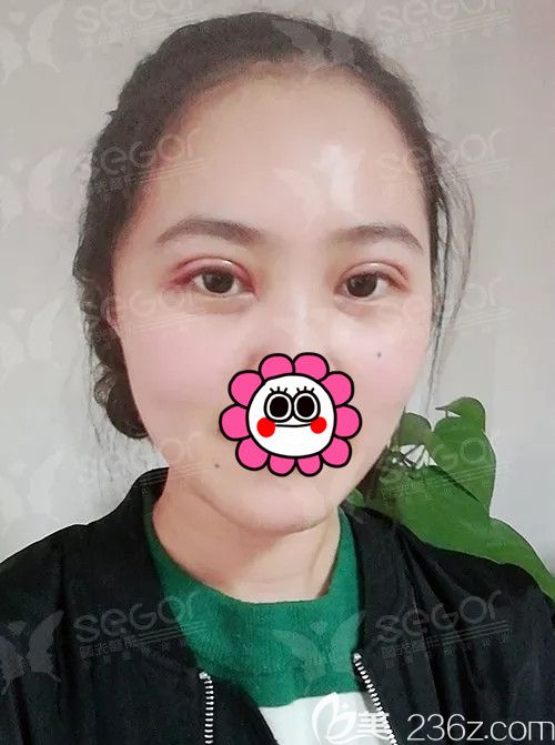 剛做完P(guān)ARK法雙眼皮術(shù)后樣子