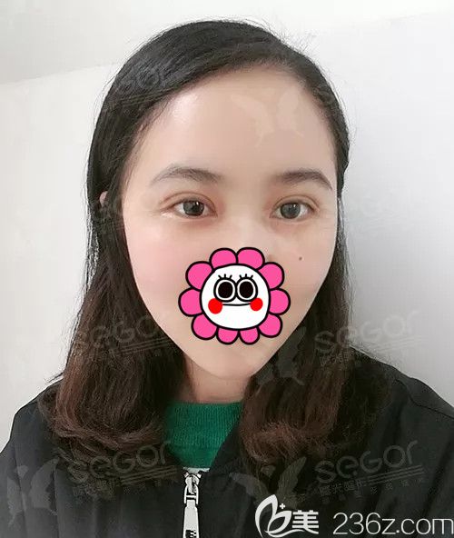 常州曙光分享做PARK法雙眼皮術(shù)后四天恢復(fù)