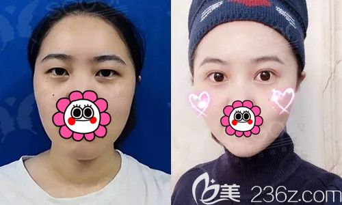 為什么PARK法雙眼皮這么火?看常州曙光真人案例給你講腫脹輕術(shù)后半月就能化妝