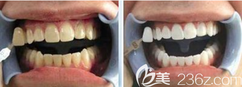 貴陽美萊牙齒美白案例