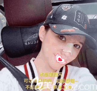 陳譽(yù)華院長為我做鼻綜合4天后基本消腫