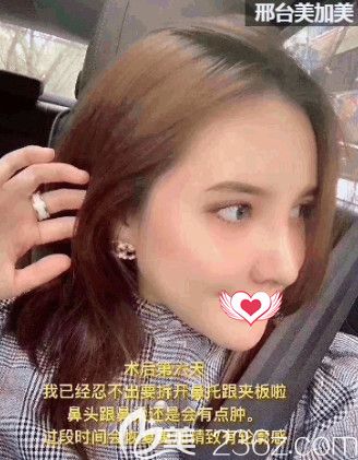 美加美整形院長陳譽(yù)華做鼻綜合6天進(jìn)行拆線