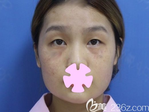 我在桂林華美整形做雙眼皮和激光祛斑前照片 我在桂林華美整形做雙眼皮和激光祛斑前照片