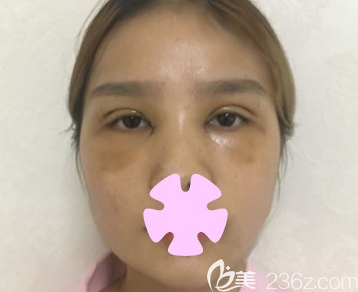 我在桂林華美整形做雙眼皮加激光祛斑第6天 我在桂林華美整形做雙眼皮加激光祛斑第6天