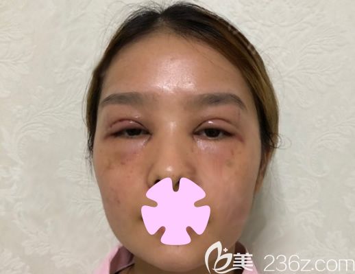 我在桂林華美做無痕雙眼皮和祛斑術(shù)后第2天 我在桂林華美做無痕雙眼皮和祛斑術(shù)后第2天