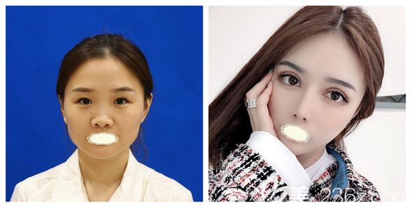 西安壹加壹全切雙眼皮+膨體隆鼻術(shù)后真實(shí)案例對(duì)比圖