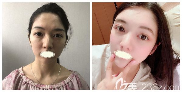 西安壹加壹美容醫(yī)院自體脂肪全面部填充術(shù)后對(duì)比案例照