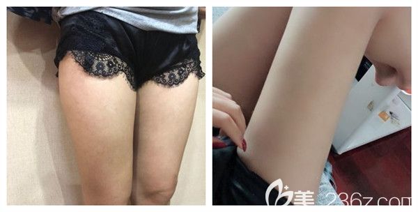 壹加壹整形美容醫(yī)院腿部吸脂術(shù)后90天真實(shí)效果展示圖