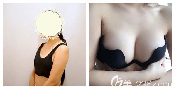 西安壹加壹醫(yī)療整形美容醫(yī)院自體脂肪隆胸術(shù)后真實(shí)案例