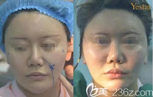 辛海龍分享埋線提升術(shù)后即刻效果 辛海龍分享埋線提升術(shù)后即刻效果