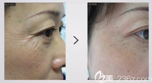 殷劉琴醫(yī)生注射除皺案例 殷劉琴醫(yī)生注射除皺案例