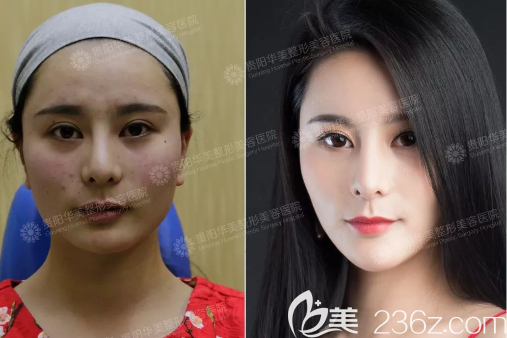 貴陽華美玻尿酸填充太陽穴案例 貴陽華美玻尿酸填充太陽穴案例