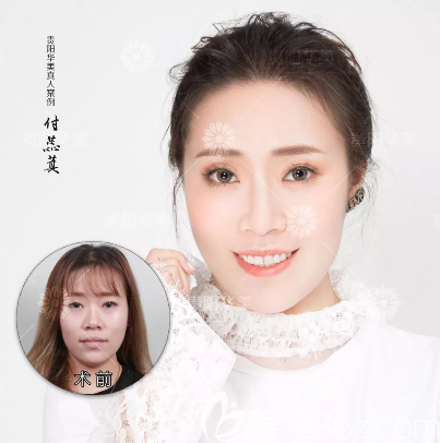 貴陽華美玻尿酸注射前后對比 貴陽華美玻尿酸注射前后對比