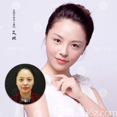 玻尿酸豐下巴案例 玻尿酸豐下巴案例