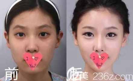 貴陽美貝爾玻尿酸隆鼻案例