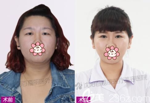 侯亞杰切開(kāi)雙眼皮真人恢復(fù)效果