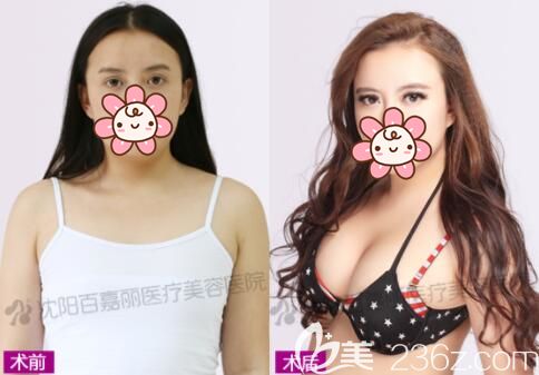 李衍江主任做假體隆胸術(shù)后255天