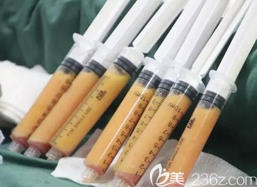 需要填充到面部凹陷處的自體脂肪