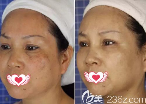 王醫(yī)生做激光祛斑案例