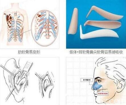 假體和自體軟骨隆鼻圖解