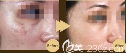 張芳輝醫(yī)生做激光祛斑案例