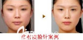 邯鄲維多利亞2月14日情人節(jié)專場優(yōu)惠來襲 580元的雙眼皮讓你超值變美