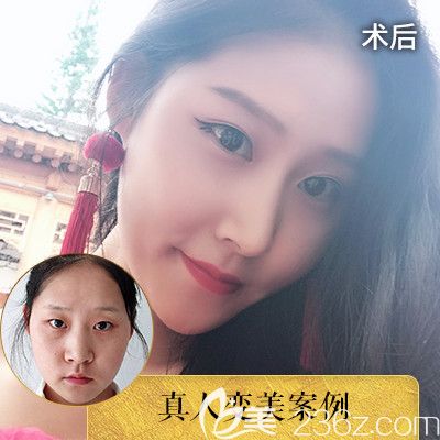 中信惠州醫(yī)院整形科羅秋雄做的隆鼻對(duì)比圖