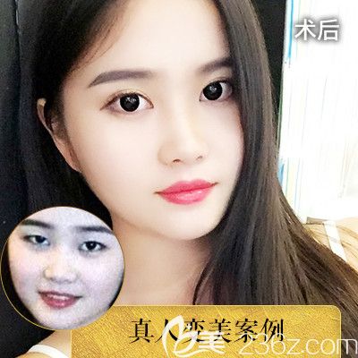 中信惠州醫(yī)院整形科羅秋雄醫(yī)生雙眼皮對(duì)比圖