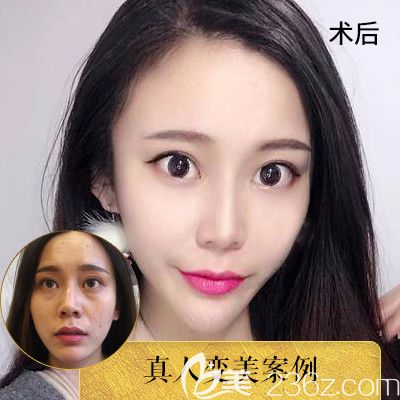 中信惠州醫(yī)院整形科羅秋雄對(duì)比圖