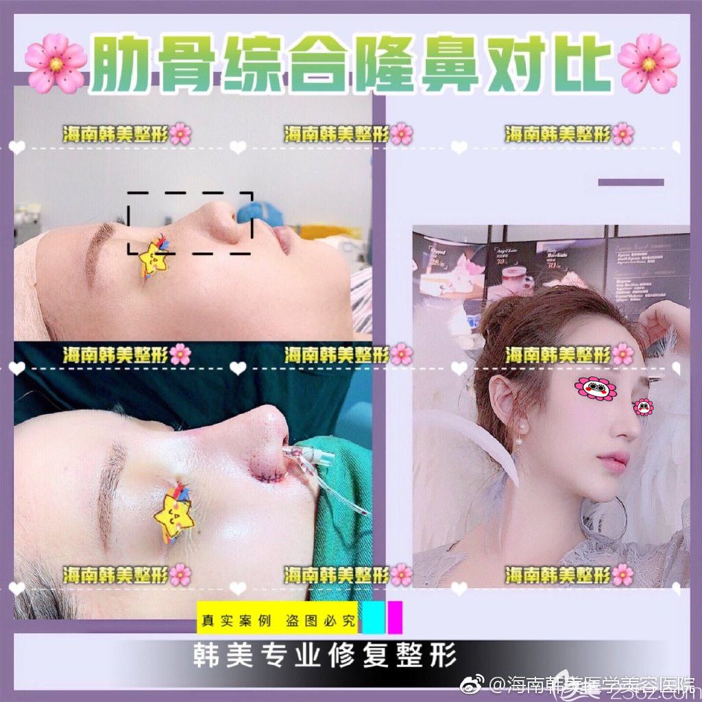 海南韓美整形隆鼻真人案例效果圖