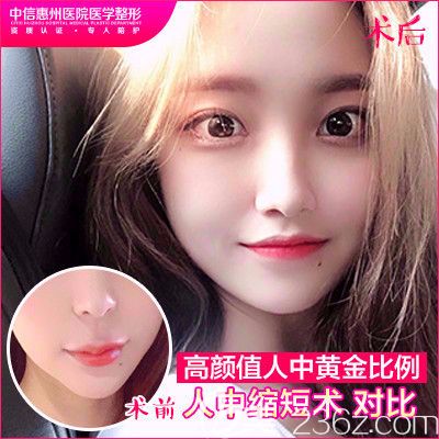 中信惠州醫(yī)院整形科羅秋雄做的人中縮短手術(shù)對(duì)比圖