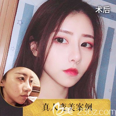 中信惠州醫(yī)院醫(yī)學(xué)整形隆鼻失敗修復(fù)對(duì)比圖