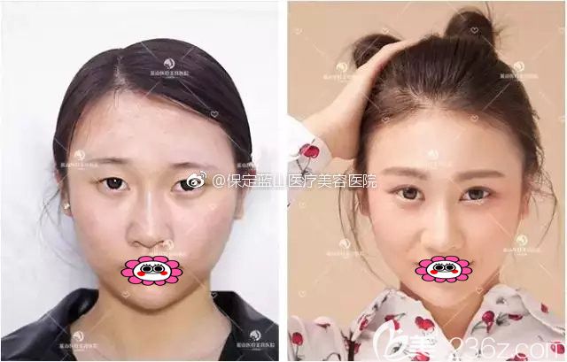 保定藍(lán)山盧闖雙眼皮效果圖