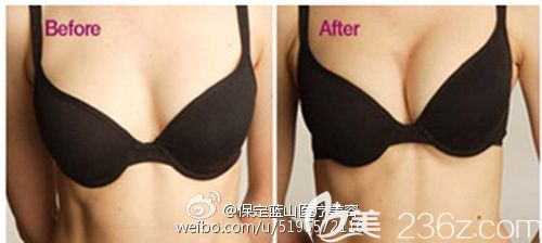保定藍(lán)山杜建龍自體脂肪豐胸對(duì)比圖