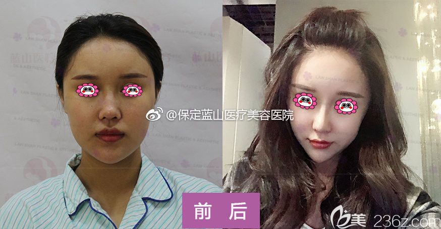 保定藍(lán)山整形醫(yī)院隆鼻真人案例變化圖