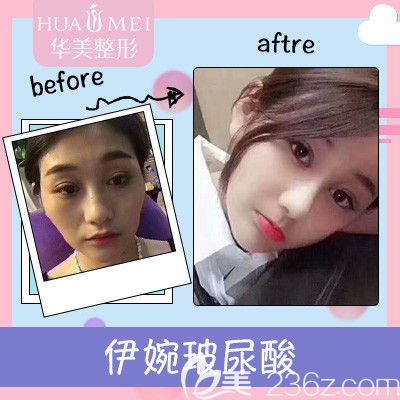 汕頭華美玻尿酸注射案例 汕頭華美玻尿酸注射案例