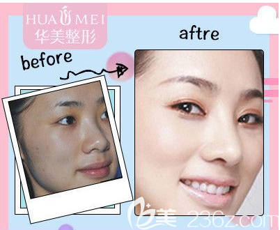 汕頭華美注射案例效果圖 汕頭華美注射案例效果圖
