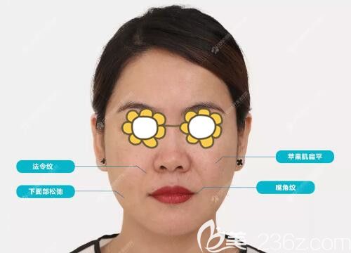 面部線雕+玻尿酸填充術(shù)前照 面部線雕+玻尿酸填充術(shù)前照